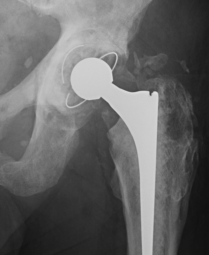 Heterotropic Bone Brooker 2